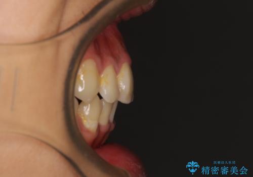 八重歯と開咬 ワイヤー装置での抜歯矯正の治療後