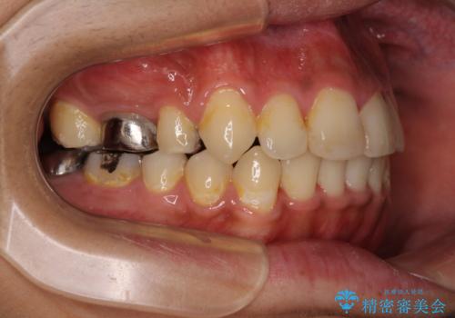 八重歯と開咬 ワイヤー装置での抜歯矯正の治療後