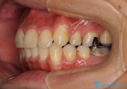 八重歯と開咬 ワイヤー装置での抜歯矯正の治療後