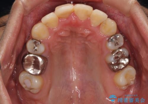 八重歯と開咬　ワイヤー装置での抜歯矯正の治療後