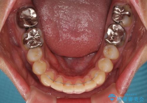 八重歯と開咬 ワイヤー装置での抜歯矯正の治療後