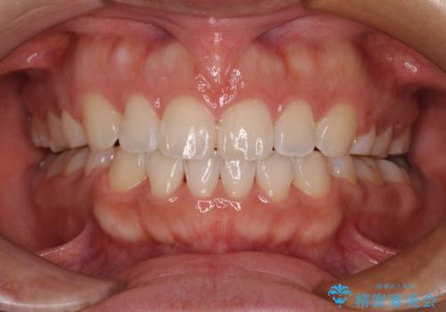 気がつくと唇が開く 口元を下げる抜歯矯正の症例 治療後