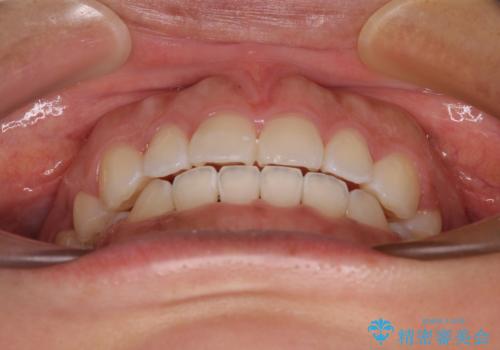 気がつくと唇が開く 口元を下げる抜歯矯正の治療後