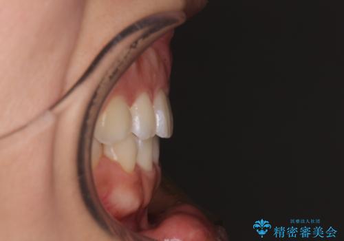 気がつくと唇が開く 口元を下げる抜歯矯正の治療後