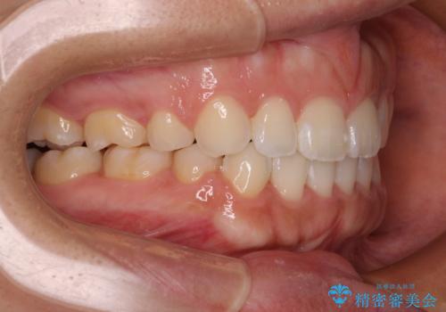 気がつくと唇が開く 口元を下げる抜歯矯正の治療後