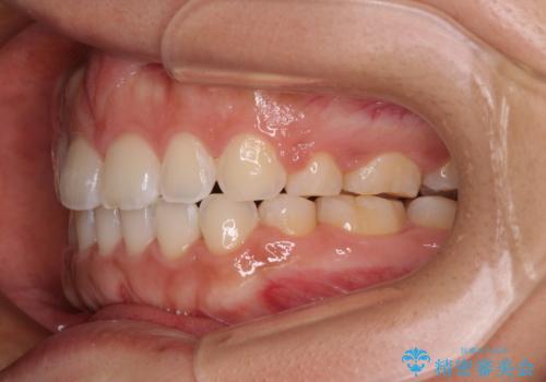 気がつくと唇が開く 口元を下げる抜歯矯正の治療後