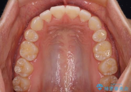 気がつくと唇が開く 口元を下げる抜歯矯正の治療後
