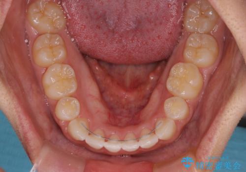 気がつくと唇が開く 口元を下げる抜歯矯正の治療後