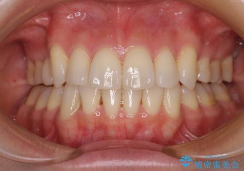 デコボコで磨きにくい歯列　ワイヤー装置での抜歯矯正で歯磨きをしやすくの治療後