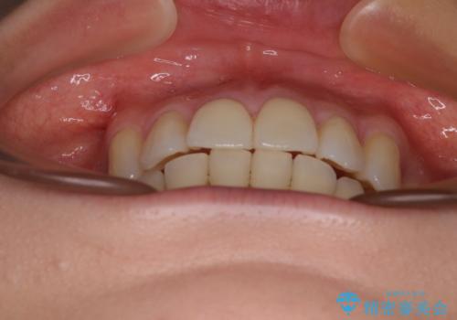 デコボコで磨きにくい歯列 ワイヤー装置での抜歯矯正で歯磨きをしやすくの治療後