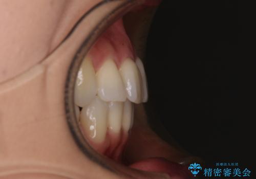 デコボコで磨きにくい歯列 ワイヤー装置での抜歯矯正で歯磨きをしやすくの治療後