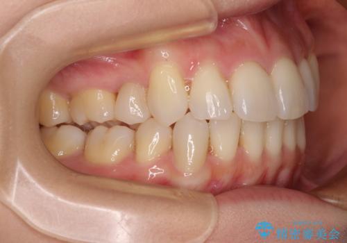 デコボコで磨きにくい歯列 ワイヤー装置での抜歯矯正で歯磨きをしやすくの治療後