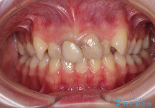 変色したバランスの悪い前歯をオールセラミッククラウンで自然な口元にの治療前