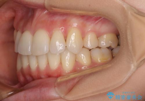 デコボコで磨きにくい歯列 ワイヤー装置での抜歯矯正で歯磨きをしやすくの治療後