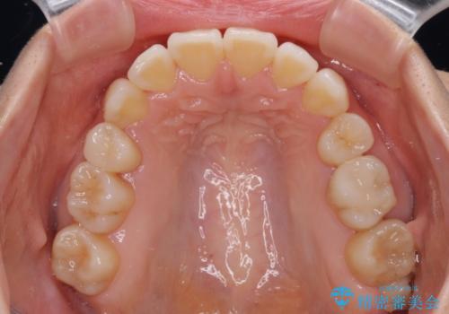 デコボコで磨きにくい歯列 ワイヤー装置での抜歯矯正で歯磨きをしやすくの治療後