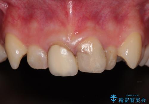 変色したバランスの悪い前歯をオールセラミッククラウンで自然な口元にの症例 治療前