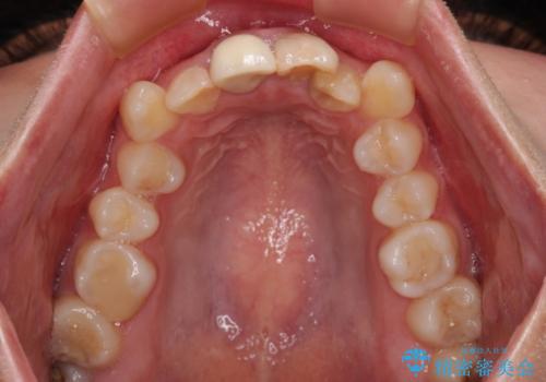 変色したバランスの悪い前歯をオールセラミッククラウンで自然な口元にの治療前