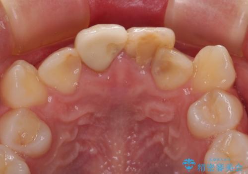 変色したバランスの悪い前歯をオールセラミッククラウンで自然な口元にの治療前