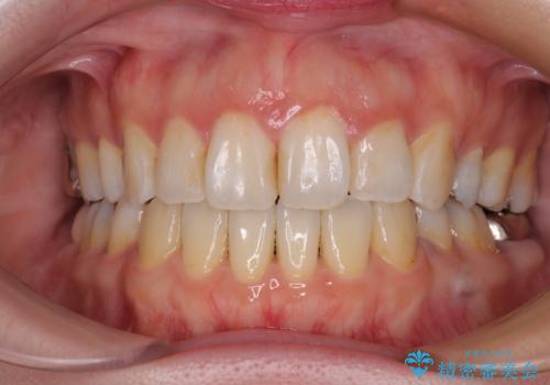 出っ歯と奥歯の欠損　ワイヤー矯正とインプラント治療の症例 治療後