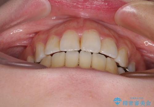 出っ歯と奥歯の欠損 ワイヤー矯正とインプラント治療の治療後