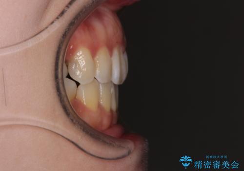 出っ歯と奥歯の欠損 ワイヤー矯正とインプラント治療の治療後