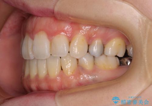 出っ歯と奥歯の欠損 ワイヤー矯正とインプラント治療の治療後