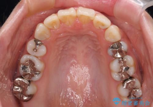 出っ歯と奥歯の欠損 ワイヤー矯正とインプラント治療の治療後