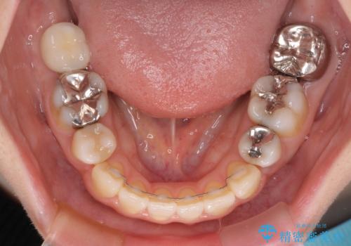出っ歯と奥歯の欠損 ワイヤー矯正とインプラント治療の治療後