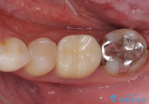 欠けてしまった奥歯 セラミッククラウンとセラミックインレーによるむし歯治療の治療後