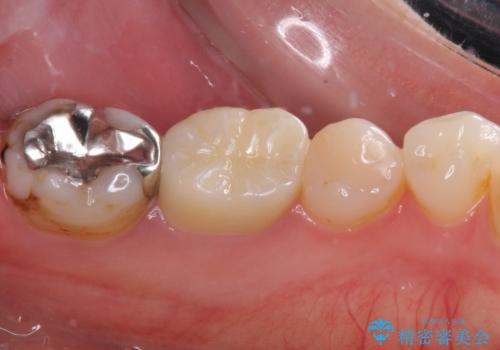 欠けてしまった奥歯 セラミッククラウンとセラミックインレーによるむし歯治療の治療後