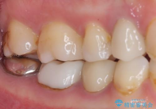 欠けてしまった奥歯 セラミッククラウンとセラミックインレーによるむし歯治療の治療後