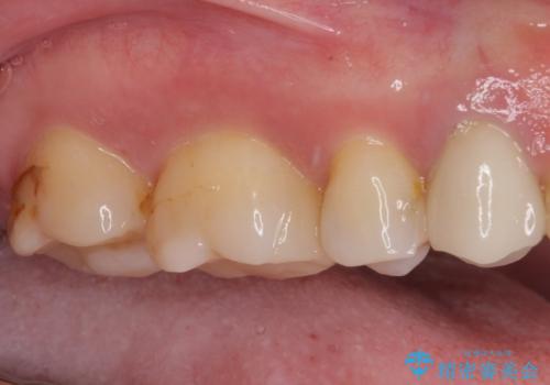 欠けてしまった奥歯 セラミッククラウンとセラミックインレーによるむし歯治療の治療後