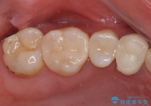 欠けてしまった奥歯 セラミッククラウンとセラミックインレーによるむし歯治療の症例 治療後