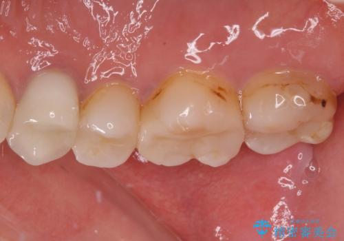 欠けてしまった奥歯 セラミッククラウンとセラミックインレーによるむし歯治療の治療後