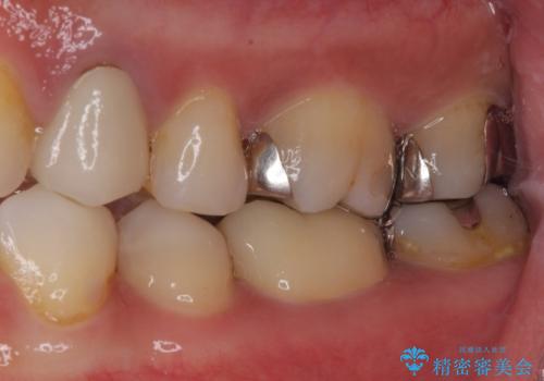 欠けてしまった奥歯 セラミッククラウンとセラミックインレーによるむし歯治療の治療後