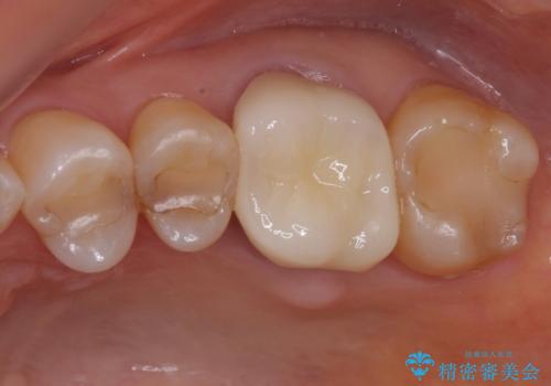 境目にものが詰まって気になる オールセラミッククラウン治療の症例 治療後