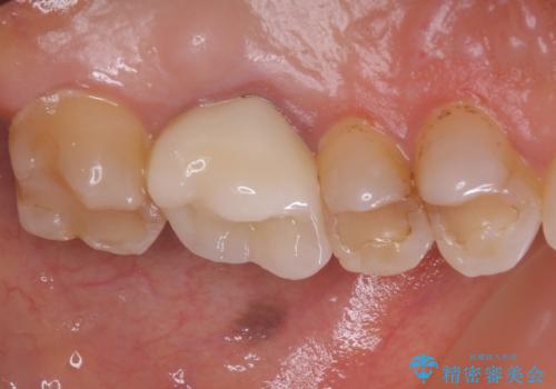 境目にものが詰まって気になる オールセラミッククラウン治療の治療後