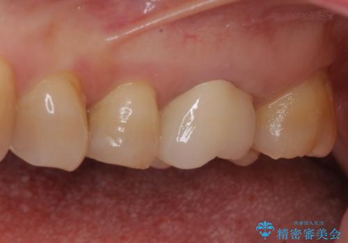 境目にものが詰まって気になる オールセラミッククラウン治療の治療後