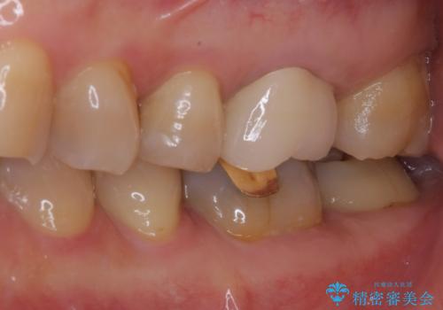 境目にものが詰まって気になる オールセラミッククラウン治療の治療後