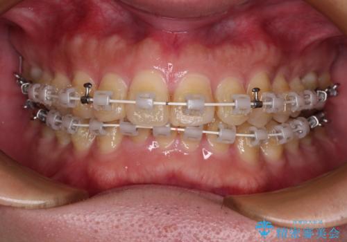 深い咬み合わせで顎が疲れる ワイヤー矯正でディープバイトを解消の治療中