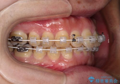 深い咬み合わせで顎が疲れる ワイヤー矯正でディープバイトを解消の治療中