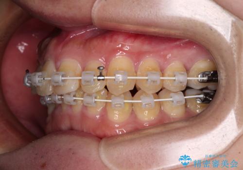 深い咬み合わせで顎が疲れる ワイヤー矯正でディープバイトを解消の治療中