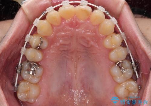 深い咬み合わせで顎が疲れる ワイヤー矯正でディープバイトを解消の治療中