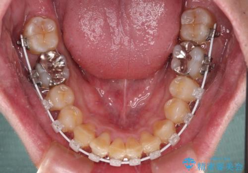 深い咬み合わせで顎が疲れる ワイヤー矯正でディープバイトを解消の治療中