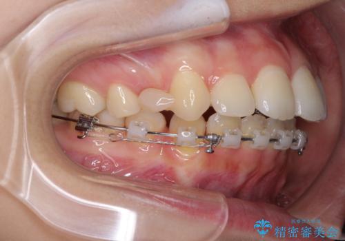 目立たない裏側装置 ハーフリンガルの抜歯矯正の治療中