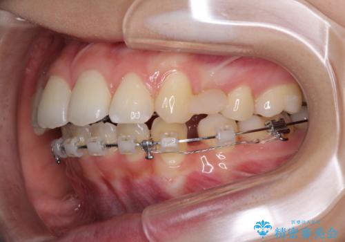 目立たない裏側装置 ハーフリンガルの抜歯矯正の治療中