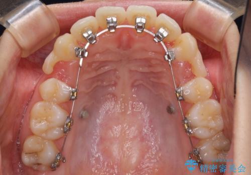 目立たない裏側装置 ハーフリンガルの抜歯矯正の治療中