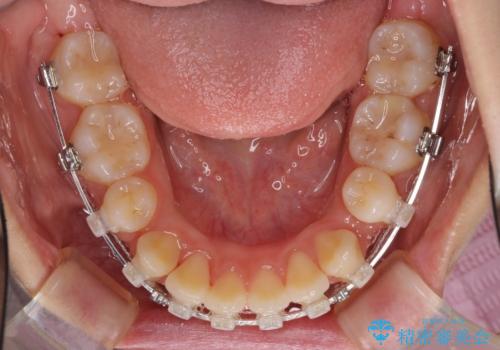 目立たない裏側装置 ハーフリンガルの抜歯矯正の治療中