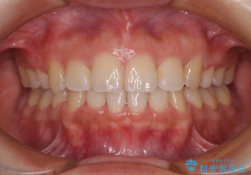 くちばしのような前歯が気になる　ワイヤー装置による抜歯矯正治療の症例 治療後