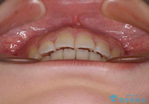 くちばしのような前歯が気になる ワイヤー装置による抜歯矯正治療の治療後